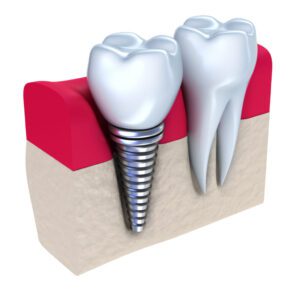 Dental implants in Louisville