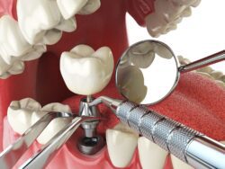 dental implant louisville