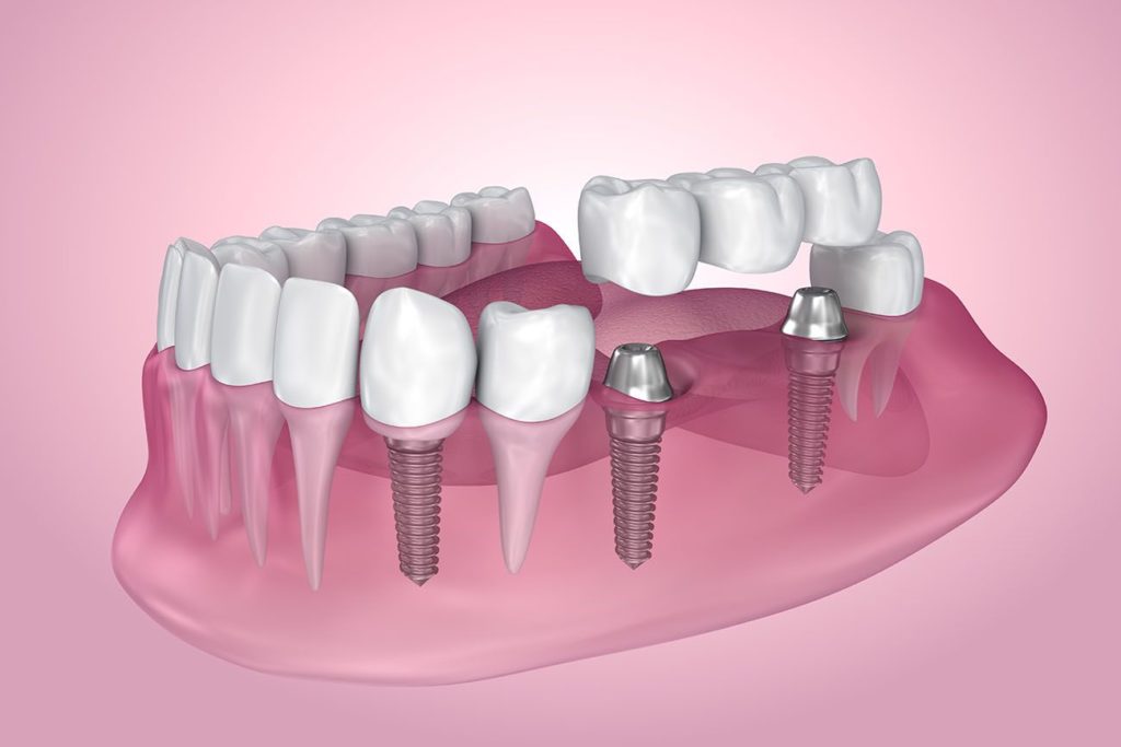 3 Dental Implants That Can Help Your Smile Dentist in Louisville, KY