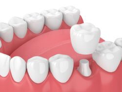 dental crown procedure Louisville Kentucky