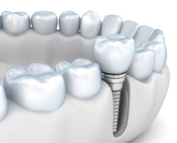 preserve jawbone with dental implants tooth replacement