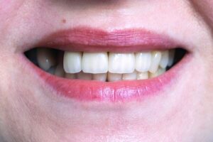 Missing Teeth and Dental Restoration