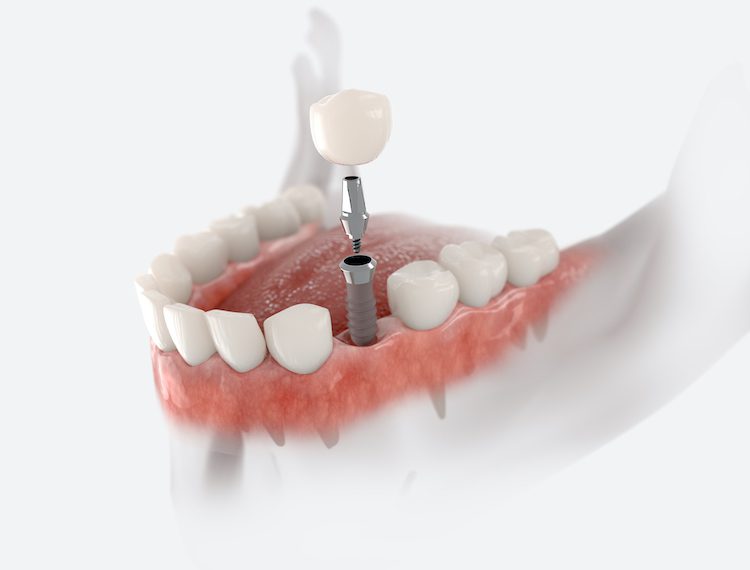 Understanding what to expect when getting a dental implant could help ease concerns and prepare you for a successful experience.